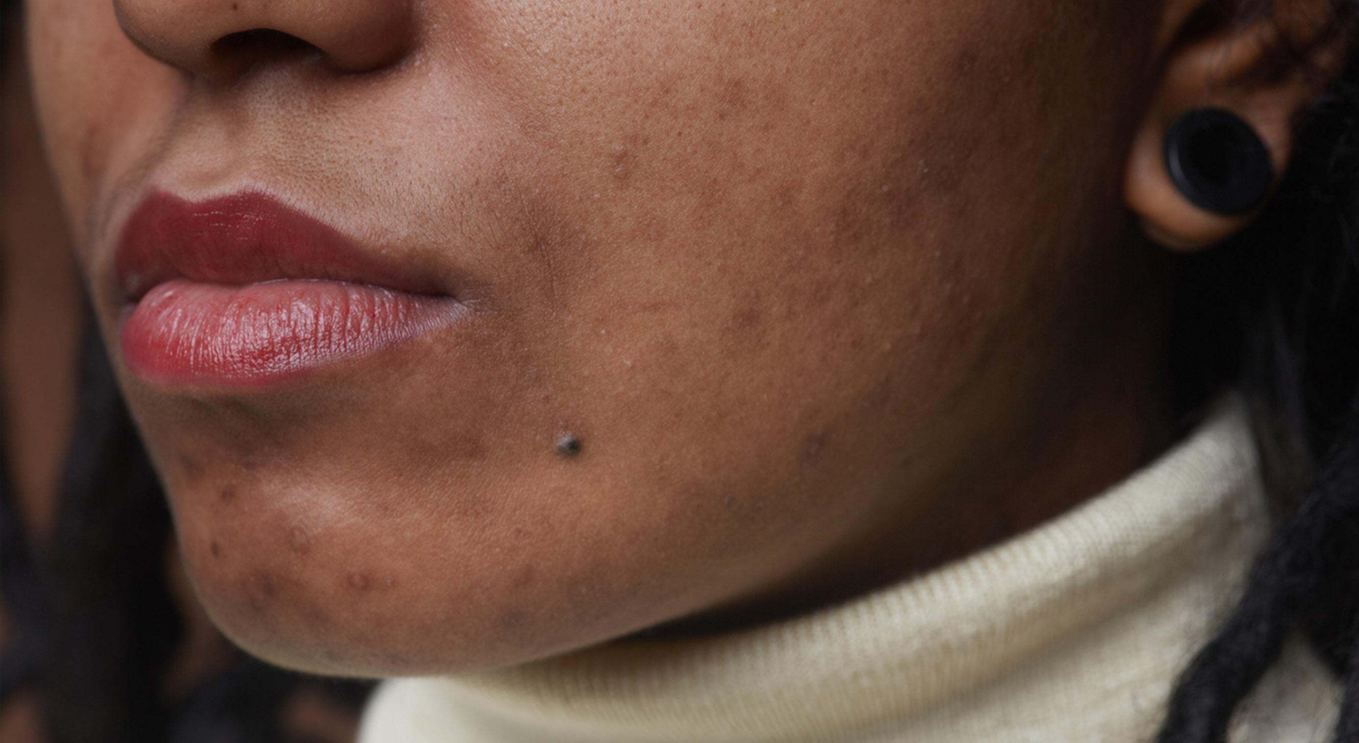 Article Hyperpigmentation
