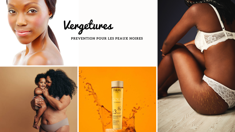 Vergetures prvention pour les peaux noires